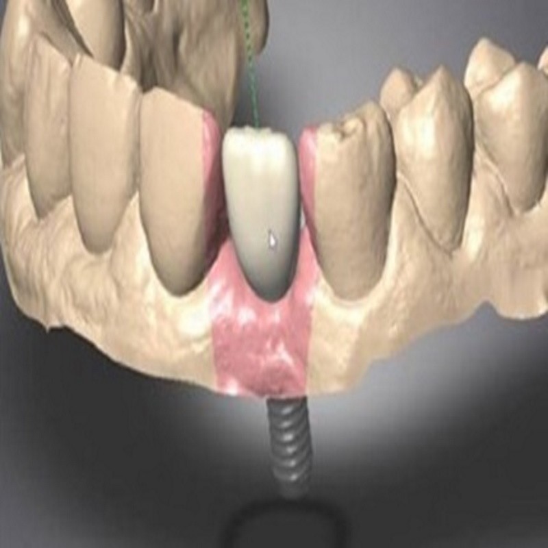 Formation implants et CFAO