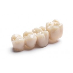 DWS LFAB, Restauration dentaire définitive avec résine zircone ou nanocomposites