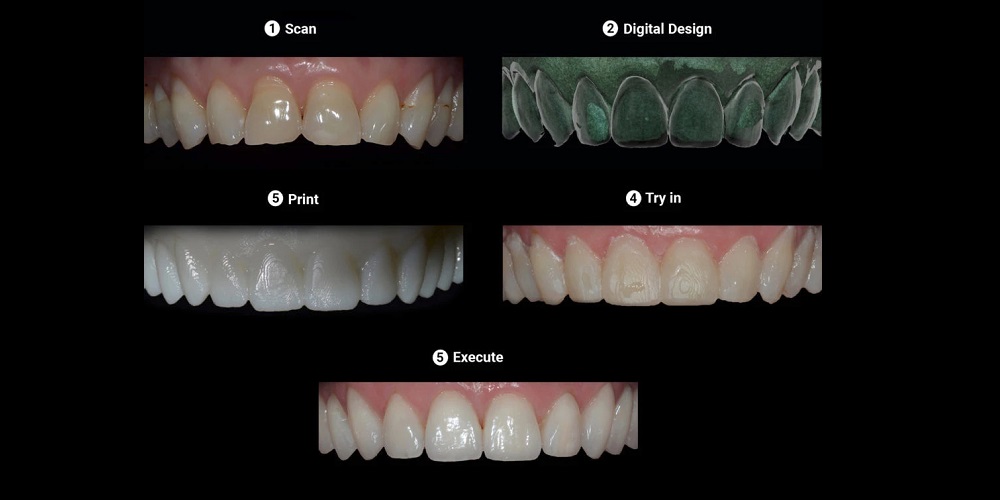 Sprintray Pro: Process dentaire