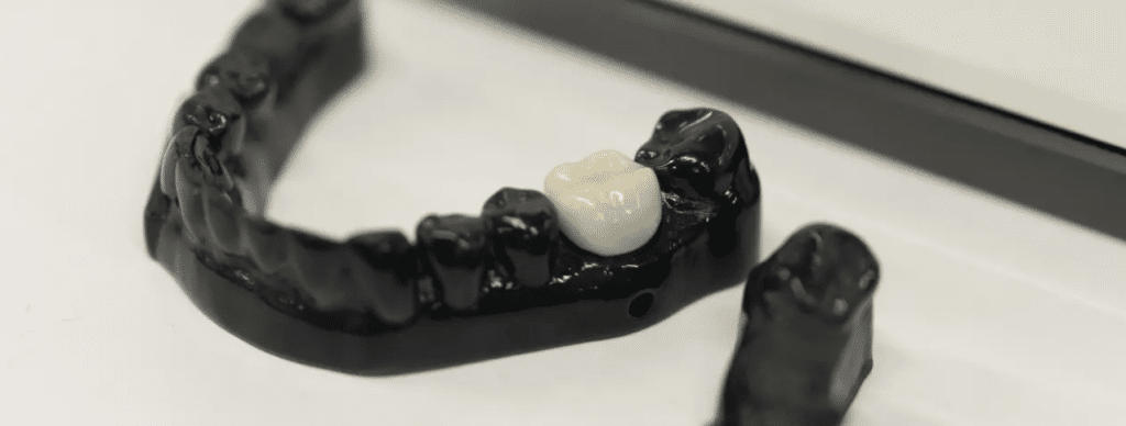 Restauration dentaire imprimée avec Crown Kit posée sur un modèle