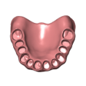 Prothèse totale type 1