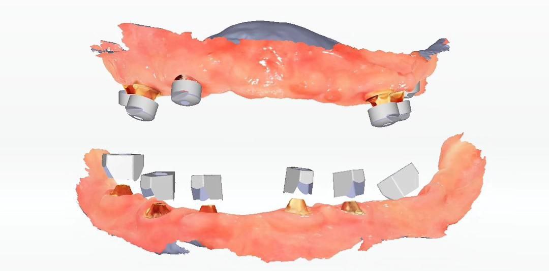 imagerie d'un palai avec photogrammétrie intra-orale de l'Aoralscan Elite