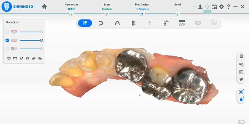 Shining 3D Aoralscan 3 sans fil  visualisation d'un balayage des métaux