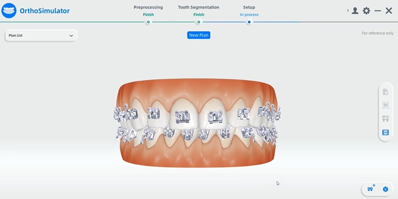 Shining 3D Aoralscan 3 sans fil visualisation d'une ortho-simulation