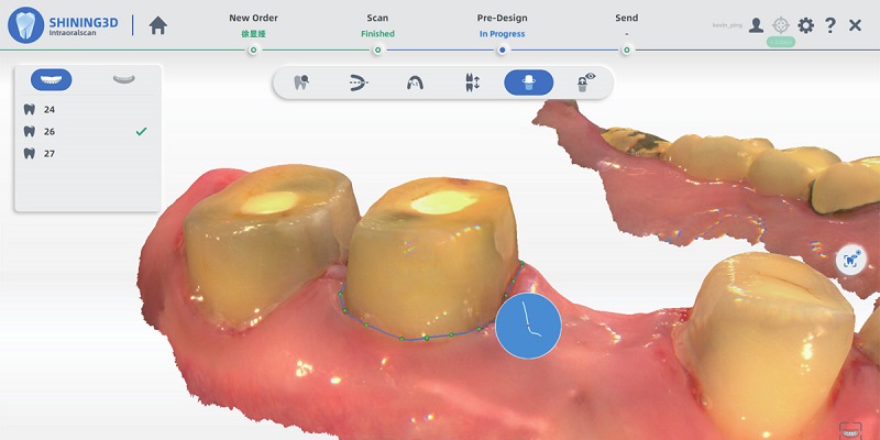 Repérage automatique du bord gingival avec AoralScan 3