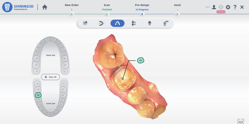 Pointage de dent avec AoralScan 3