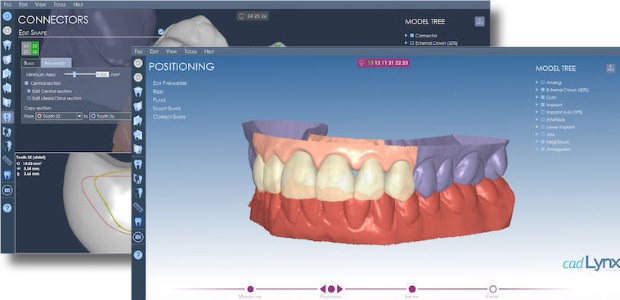 Vue d'écrans CAD Lynx, Modèle dentaire