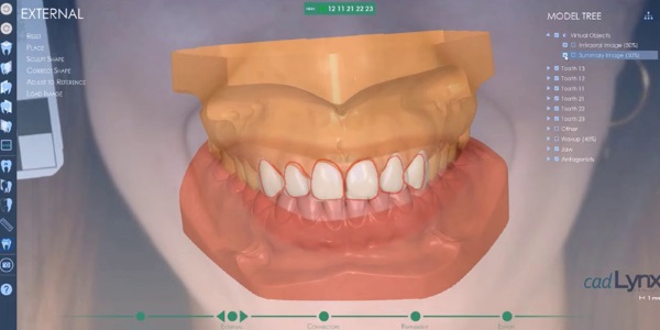 Vue d'écrans CAD Lynx, Facettes dentaires