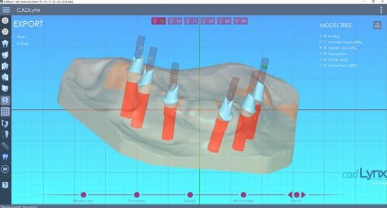 Implants avec CAD Lynx