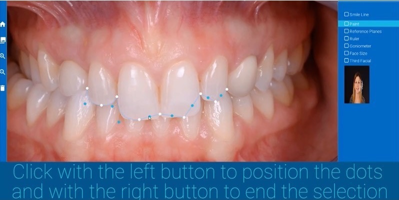 Process Smile Design avec Smile Lynx et Cad Lynx