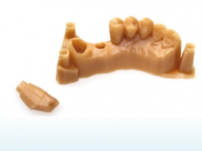 Restaurations permanentes sur les dents et les implants naturels par DWS